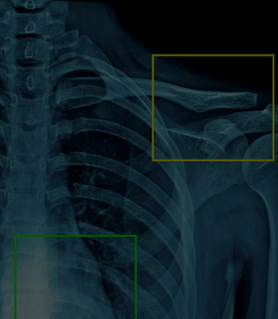 Xray Film Object Localization